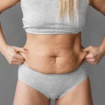 Restoring Breast Contour After Pregnancy and Weight Loss